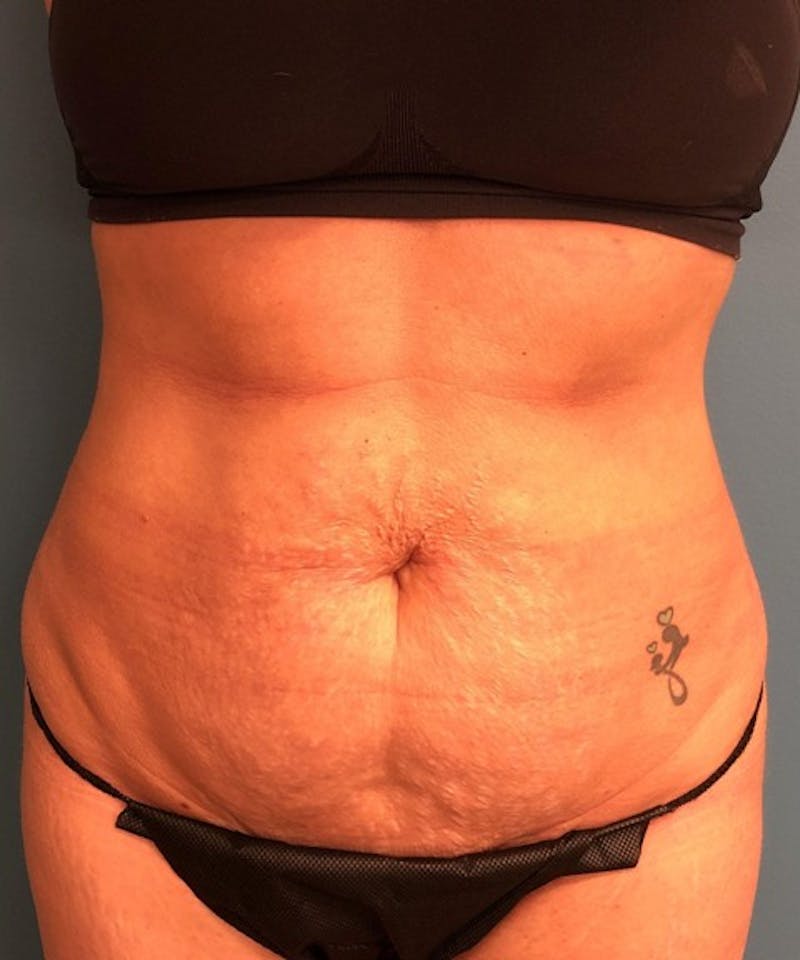 Tummy Tuck Before & After Gallery - Patient 189620 - Image 1