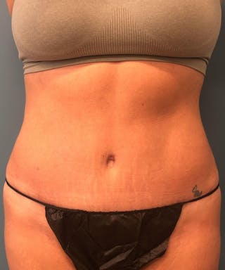 Tummy Tuck Before & After Gallery - Patient 189620 - Image 2