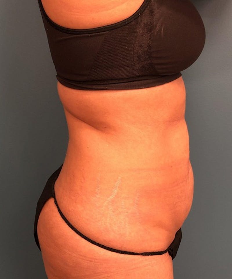 Tummy Tuck Before & After Gallery - Patient 189620 - Image 3