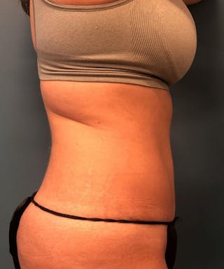 Tummy Tuck Before & After Gallery - Patient 189620 - Image 4