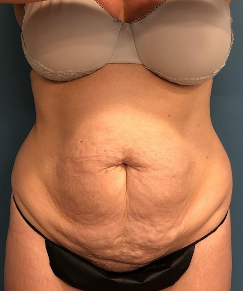 Tummy Tuck Before & After Gallery - Patient 292474 - Image 1