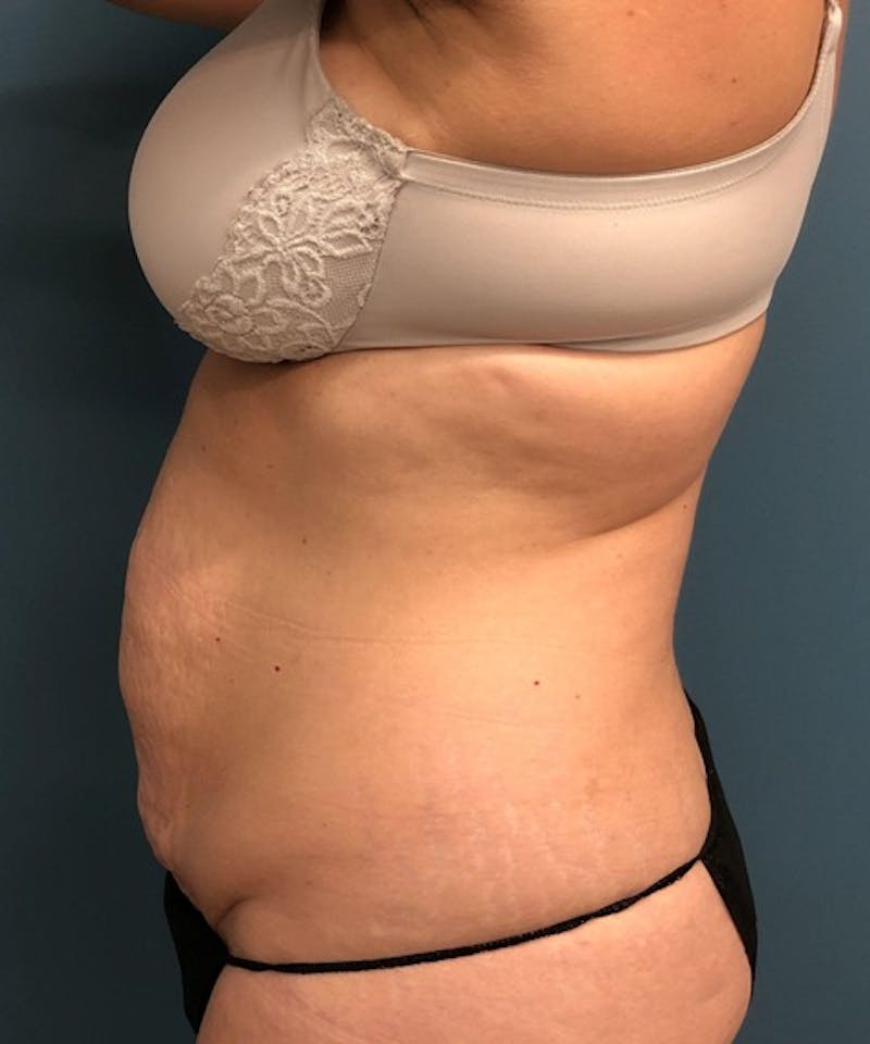 Tummy Tuck Before & After Gallery - Patient 292474 - Image 3
