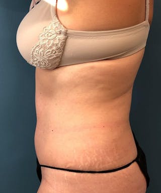 Tummy Tuck Before & After Gallery - Patient 292474 - Image 4