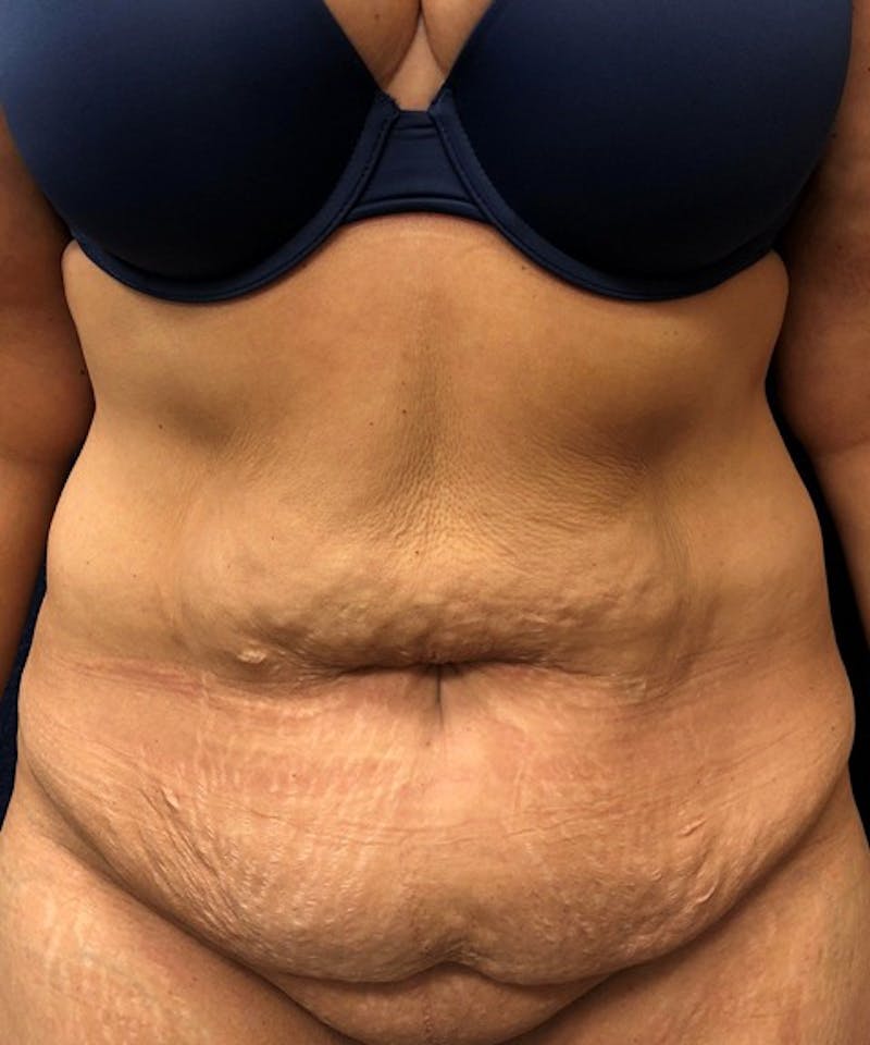 Tummy Tuck Before & After Gallery - Patient 195184 - Image 1