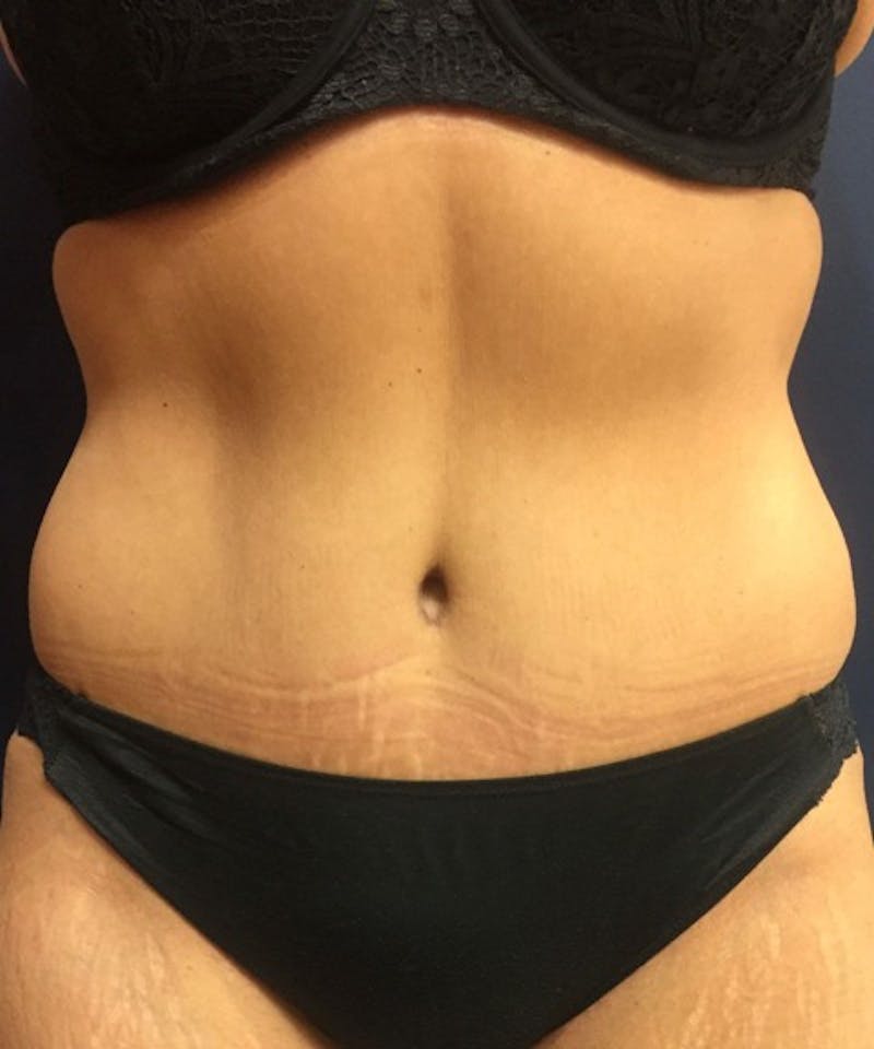 Tummy Tuck Before & After Gallery - Patient 195184 - Image 2