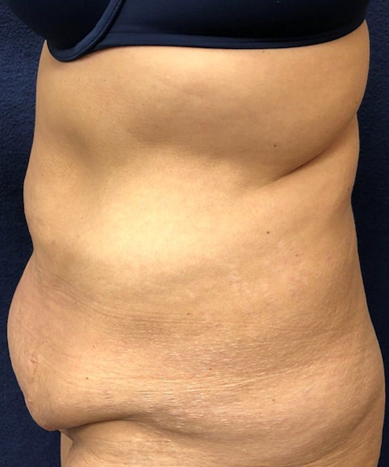Tummy Tuck Before & After Gallery - Patient 195184 - Image 3