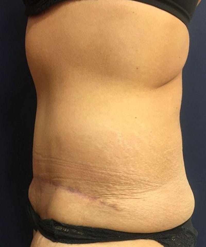 Tummy Tuck Before & After Gallery - Patient 195184 - Image 4