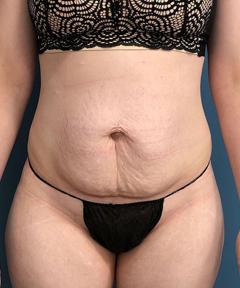 Tummy Tuck Before & After Gallery - Patient 211388 - Image 1