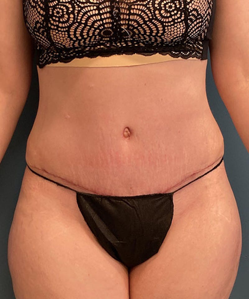Tummy Tuck Before & After Gallery - Patient 211388 - Image 2