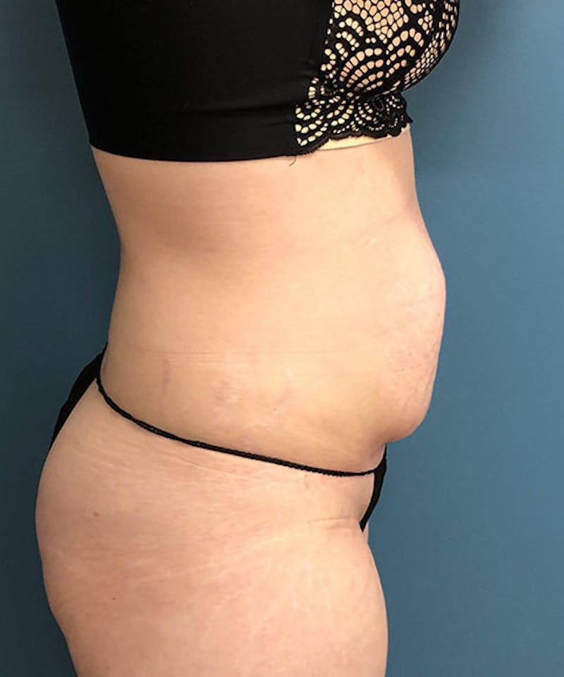 Tummy Tuck Before & After Gallery - Patient 211388 - Image 3
