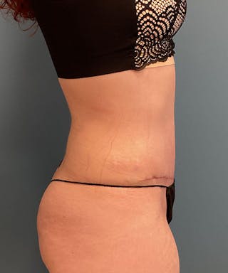 Tummy Tuck Before & After Gallery - Patient 211388 - Image 4