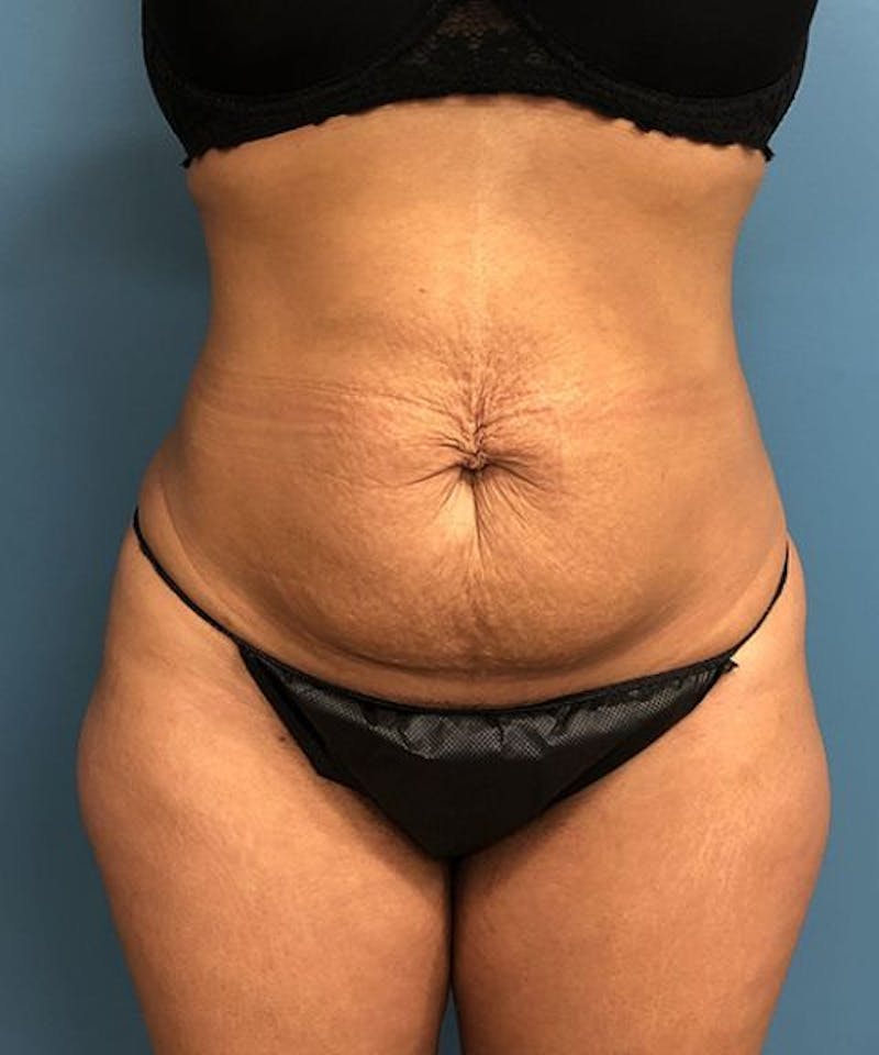 Tummy Tuck Before & After Gallery - Patient 345285 - Image 1