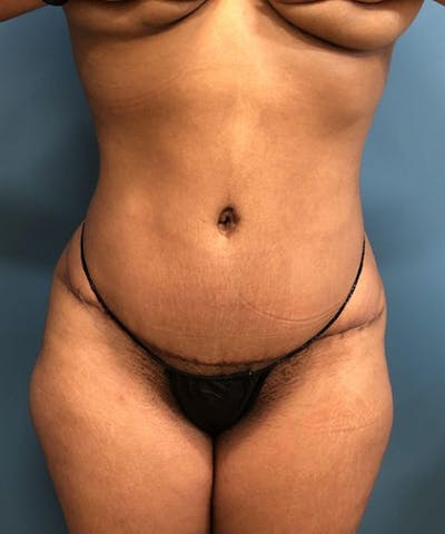 Tummy Tuck Before & After Gallery - Patient 345285 - Image 2