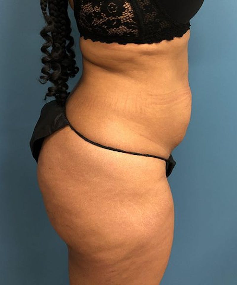 Tummy Tuck Before & After Gallery - Patient 345285 - Image 3