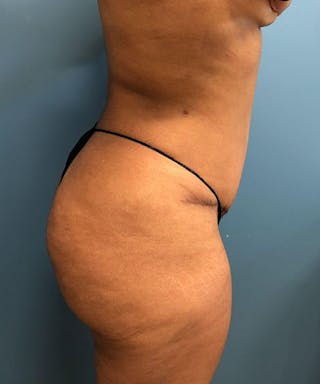 Tummy Tuck Before & After Gallery - Patient 345285 - Image 4