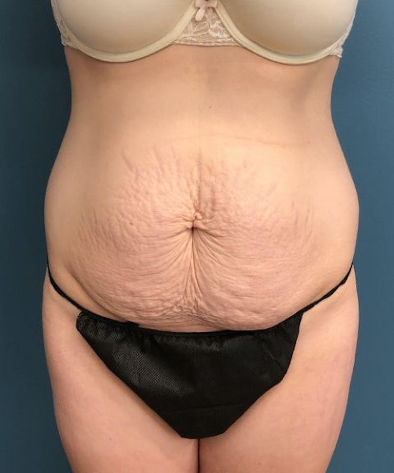 Tummy Tuck Before & After Gallery - Patient 368865 - Image 1