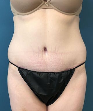 Tummy Tuck Before & After Gallery - Patient 368865 - Image 2
