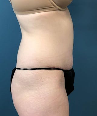 Tummy Tuck Before & After Gallery - Patient 368865 - Image 4