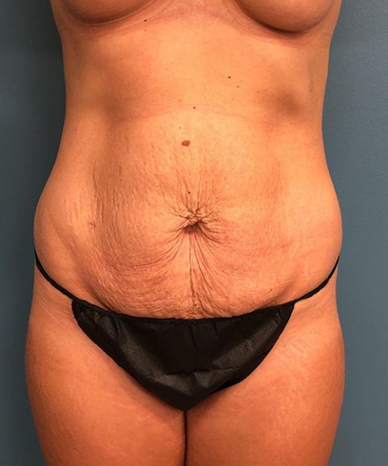 Tummy Tuck Before & After Gallery - Patient 268121 - Image 1