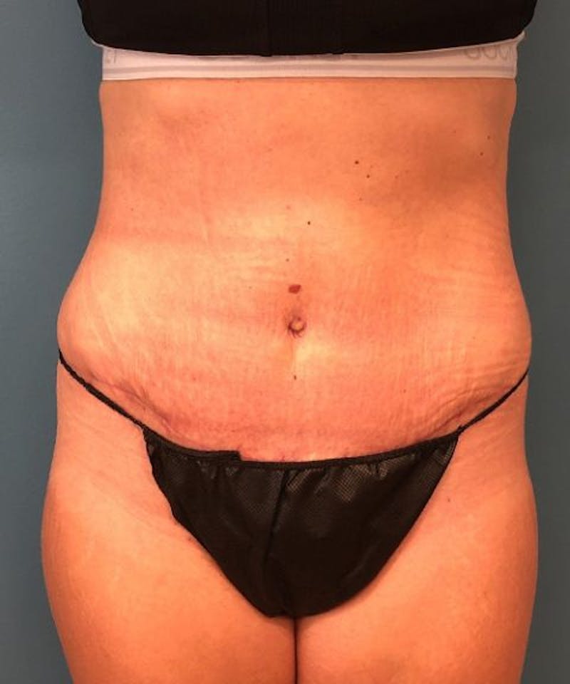Tummy Tuck Before & After Gallery - Patient 268121 - Image 2