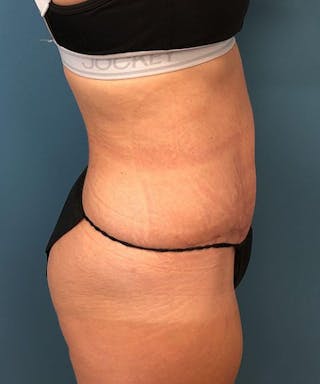 Tummy Tuck Before & After Gallery - Patient 268121 - Image 4