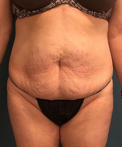 Tummy Tuck Before & After Gallery - Patient 296931 - Image 1