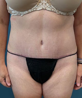 Tummy Tuck Before & After Gallery - Patient 296931 - Image 2