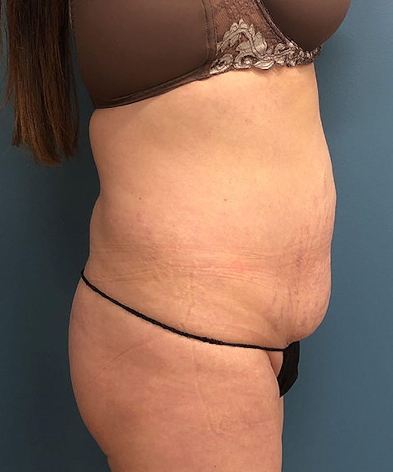 Tummy Tuck Before & After Gallery - Patient 296931 - Image 3