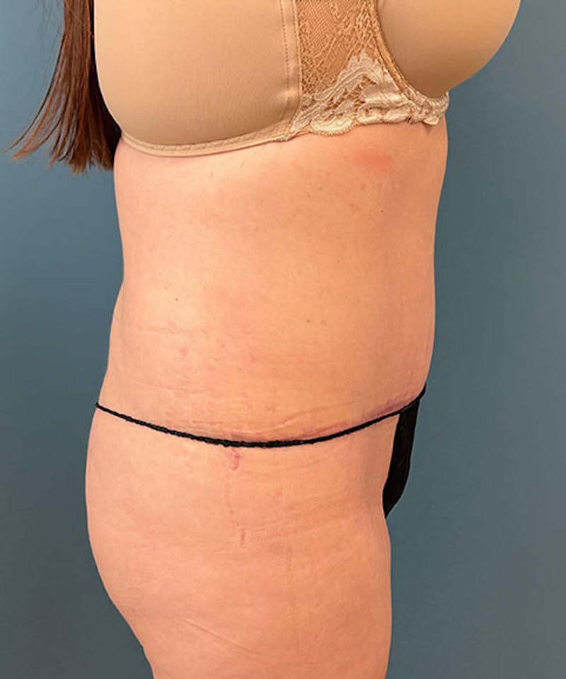 Tummy Tuck Before & After Gallery - Patient 296931 - Image 4