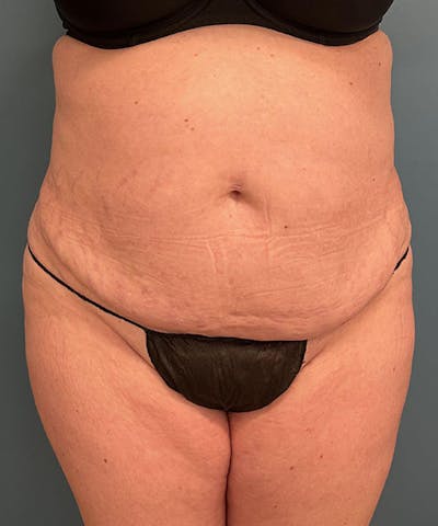 Tummy Tuck Before & After Gallery - Patient 343827 - Image 1