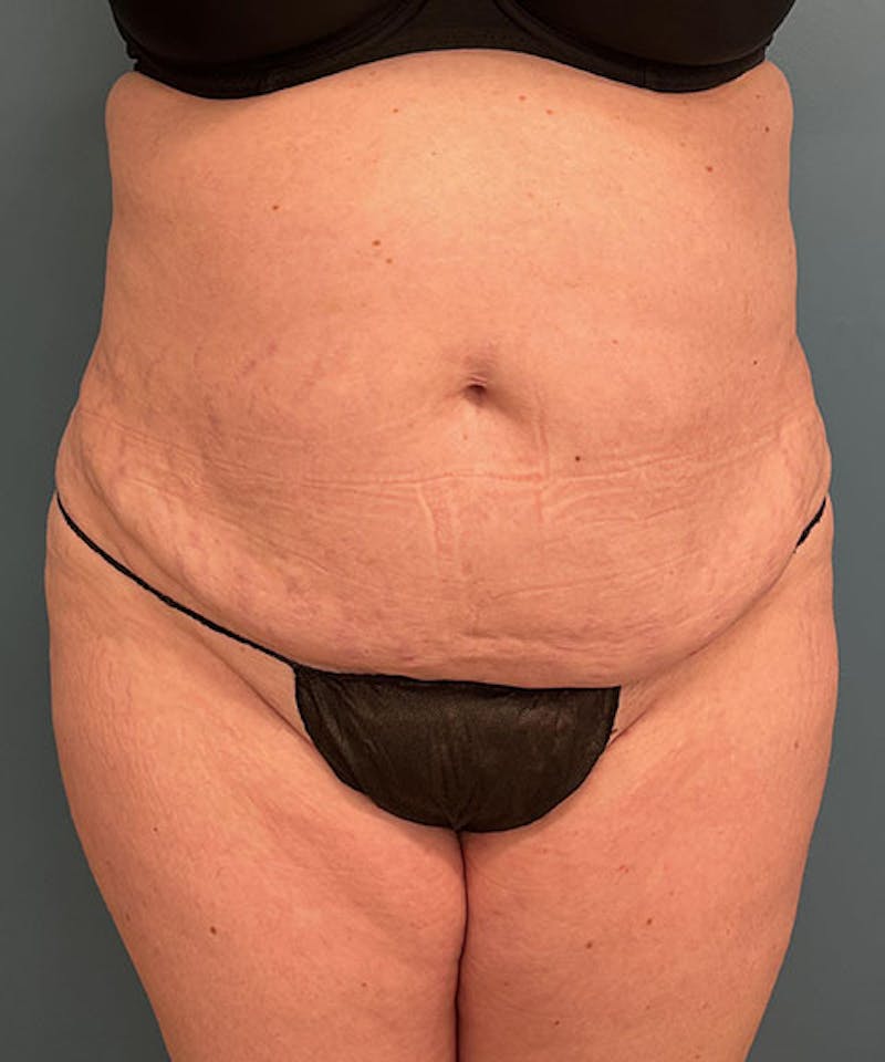 Tummy Tuck Before & After Gallery - Patient 343827 - Image 1