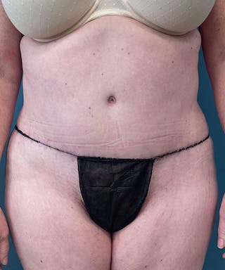 Tummy Tuck Before & After Gallery - Patient 343827 - Image 2
