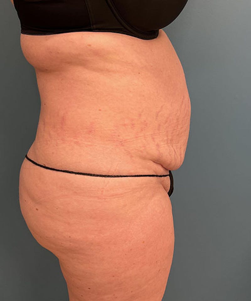Tummy Tuck Before & After Gallery - Patient 343827 - Image 3