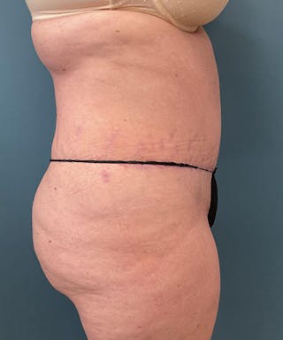 Tummy Tuck Before & After Gallery - Patient 343827 - Image 4