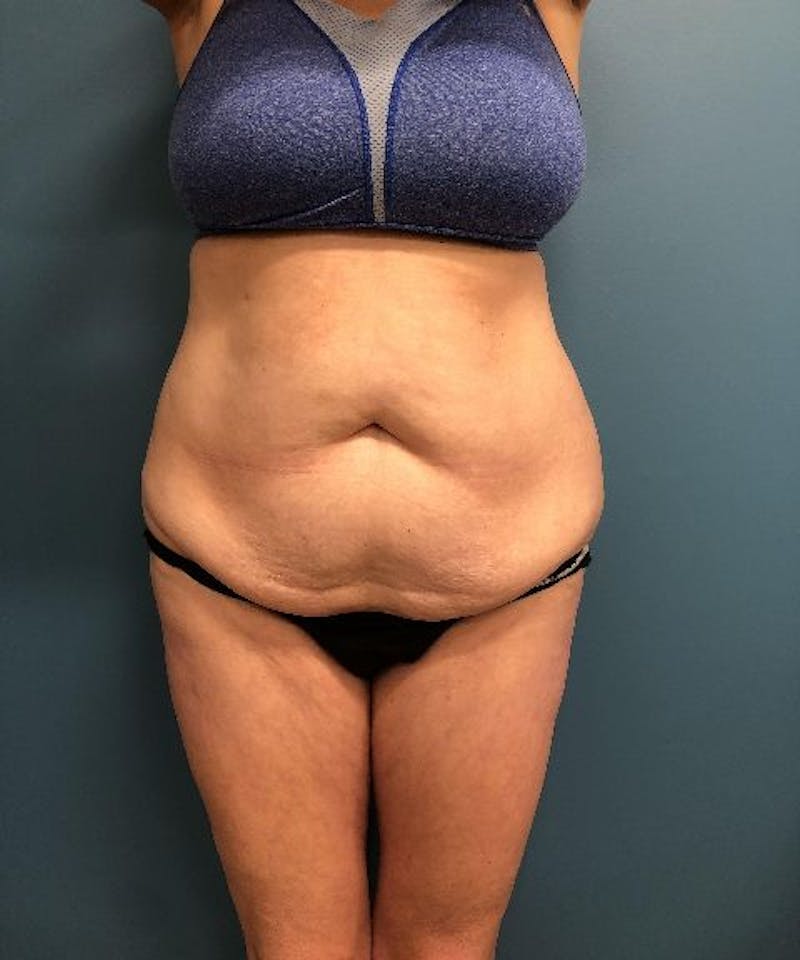 Tummy Tuck Before & After Gallery - Patient 175857 - Image 1