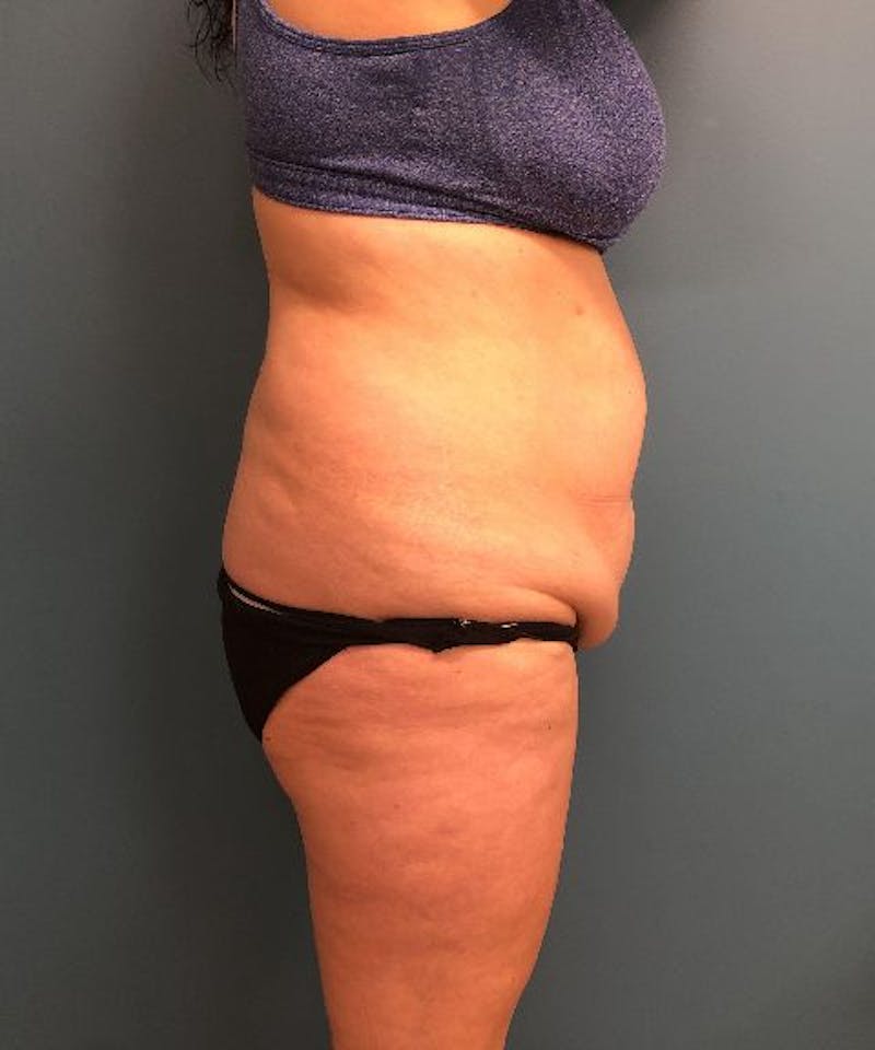 Tummy Tuck Before & After Gallery - Patient 175857 - Image 3