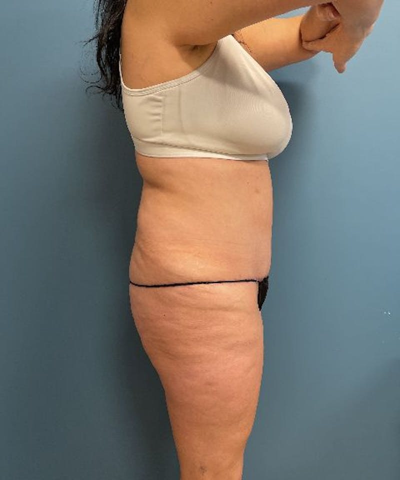 Tummy Tuck Before & After Gallery - Patient 175857 - Image 4