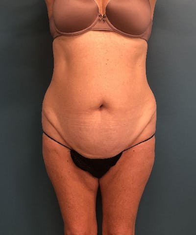 Tummy Tuck Before & After Gallery - Patient 412479 - Image 1