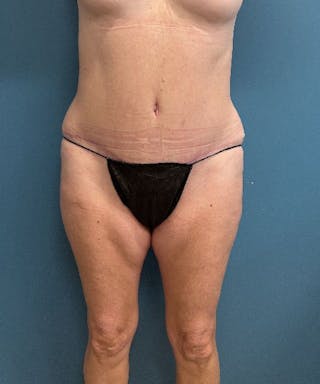 Tummy Tuck Before & After Gallery - Patient 412479 - Image 2