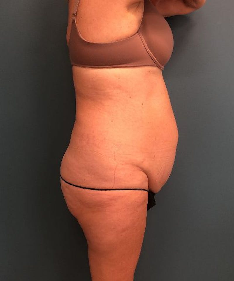 Tummy Tuck Before & After Gallery - Patient 412479 - Image 3