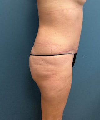 Tummy Tuck Before & After Gallery - Patient 412479 - Image 4