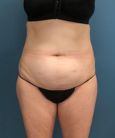 Tummy Tuck Before & After Gallery - Patient 711591 - Image 1