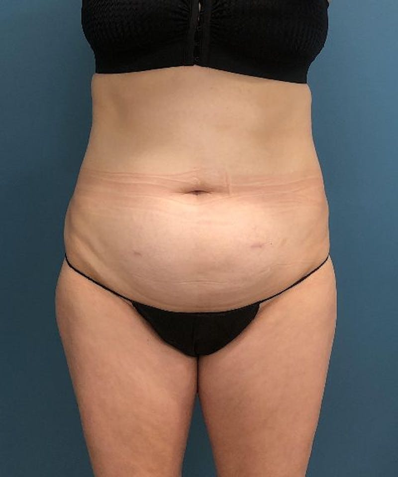 Tummy Tuck Before & After Gallery - Patient 711591 - Image 1