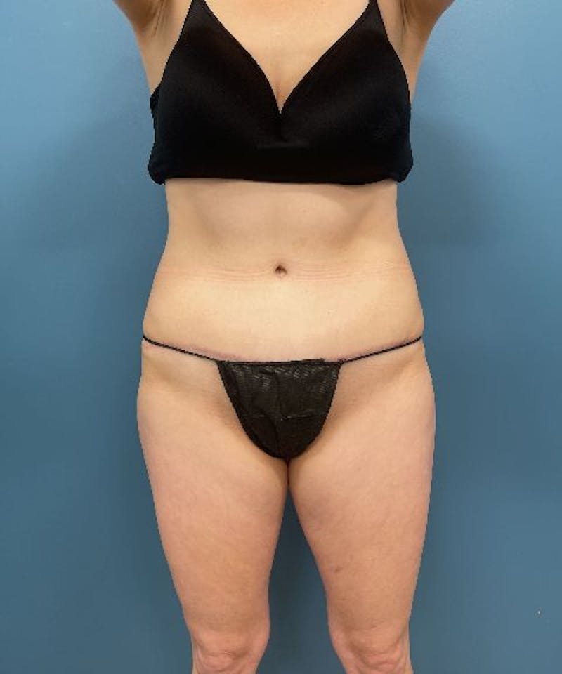 Tummy Tuck Before & After Gallery - Patient 711591 - Image 2