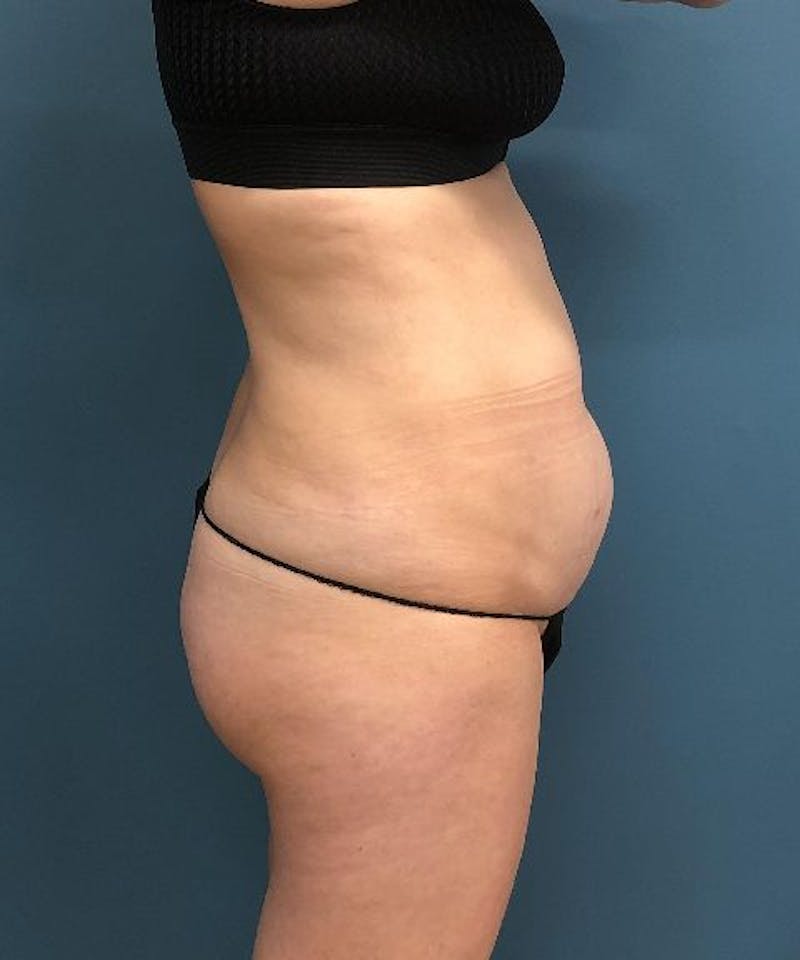 Tummy Tuck Before & After Gallery - Patient 711591 - Image 3