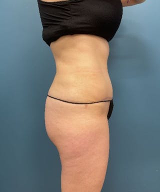 Tummy Tuck Before & After Gallery - Patient 711591 - Image 4