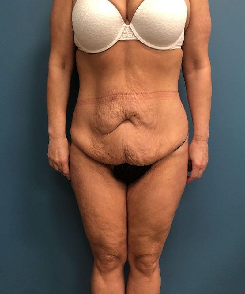 Tummy Tuck Before & After Gallery - Patient 180091 - Image 1