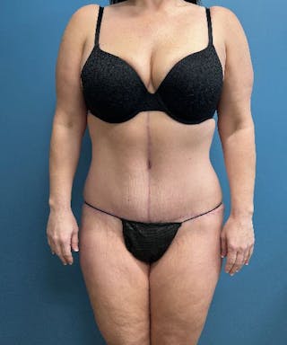 Tummy Tuck Before & After Gallery - Patient 180091 - Image 2
