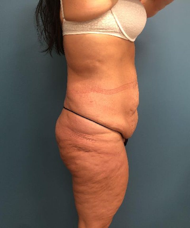 Tummy Tuck Before & After Gallery - Patient 180091 - Image 3