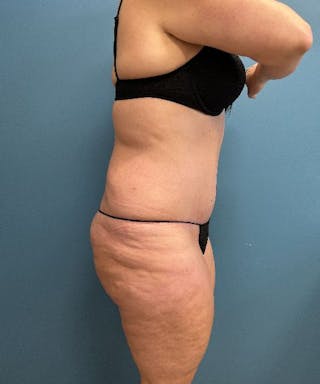 Tummy Tuck Before & After Gallery - Patient 180091 - Image 4